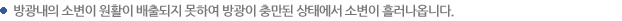 방광내의 소변이 원활이 배출되지 못하여 방광이 충만된 상태에서 소변이 흘러나옵니다.