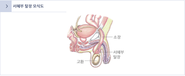 서혜부 탈장 모식도 이미지