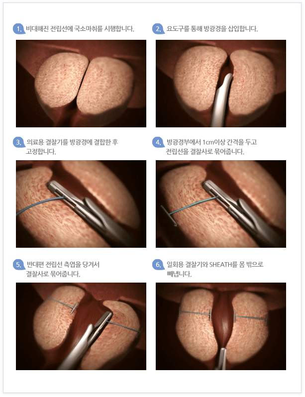 시술순서 이미지